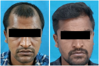 Hair Transplant Treatment